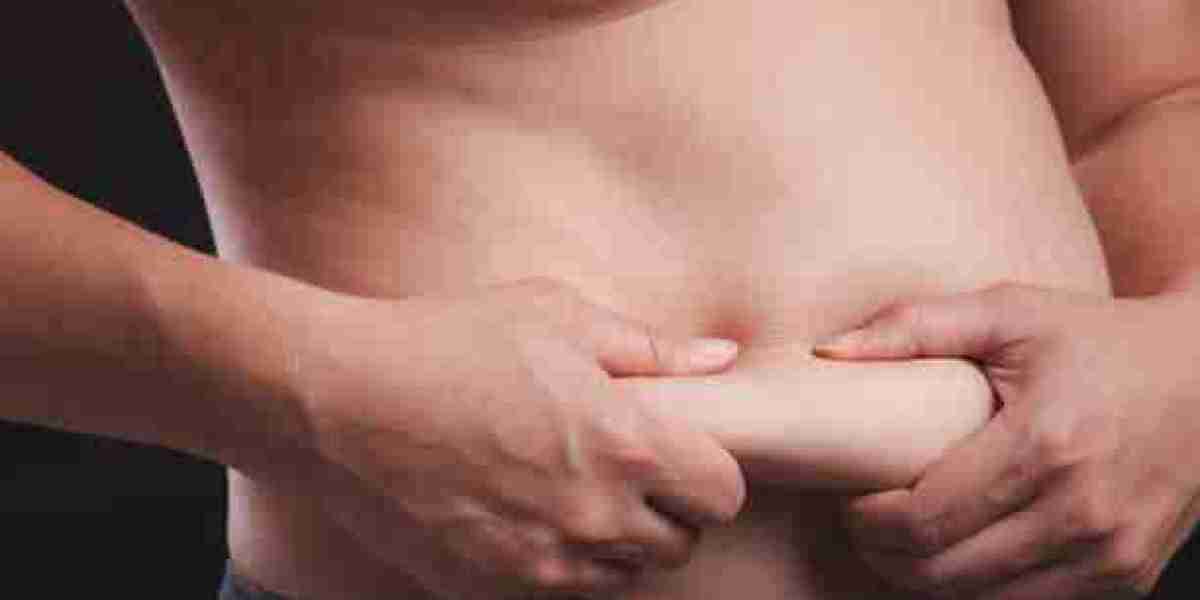 Your Complete Guide to Preparing for a Tummy Tuck in Riyadh