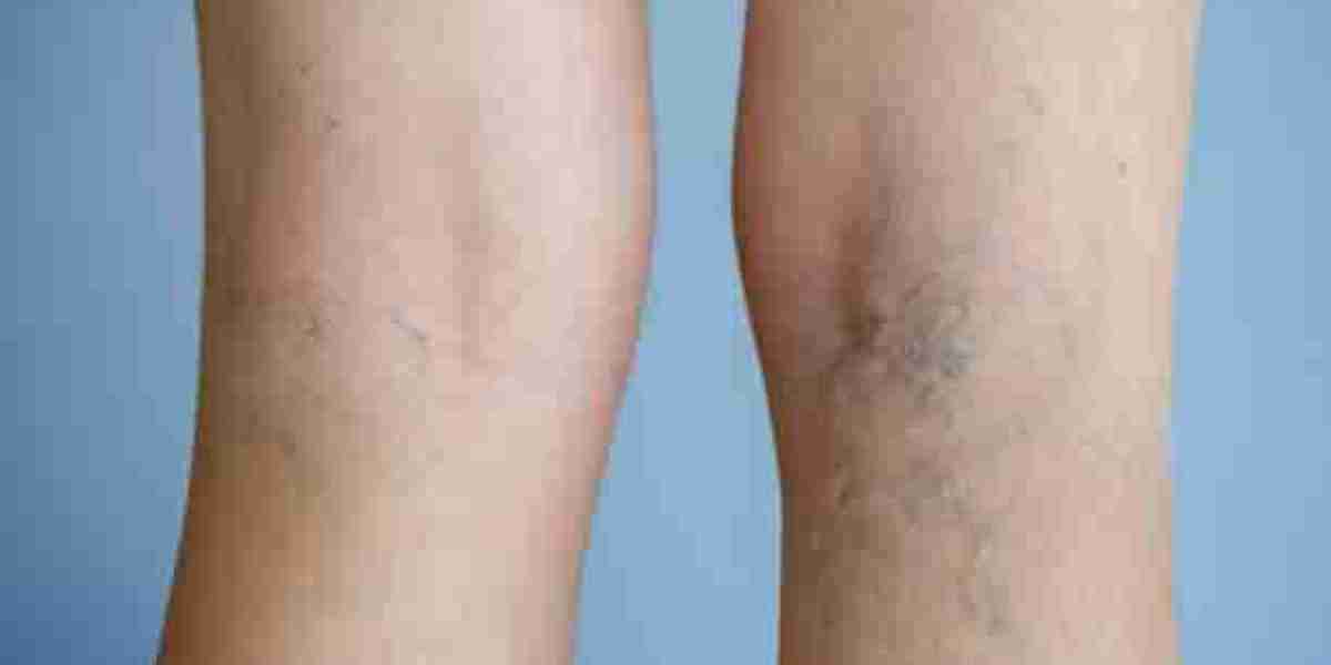 Smooth Recovery with Varicose Veins Treatment Options