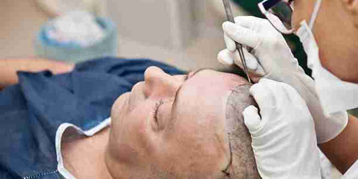 Hair Transplant in Riyadh for Advanced Hair Restoration Techniques
