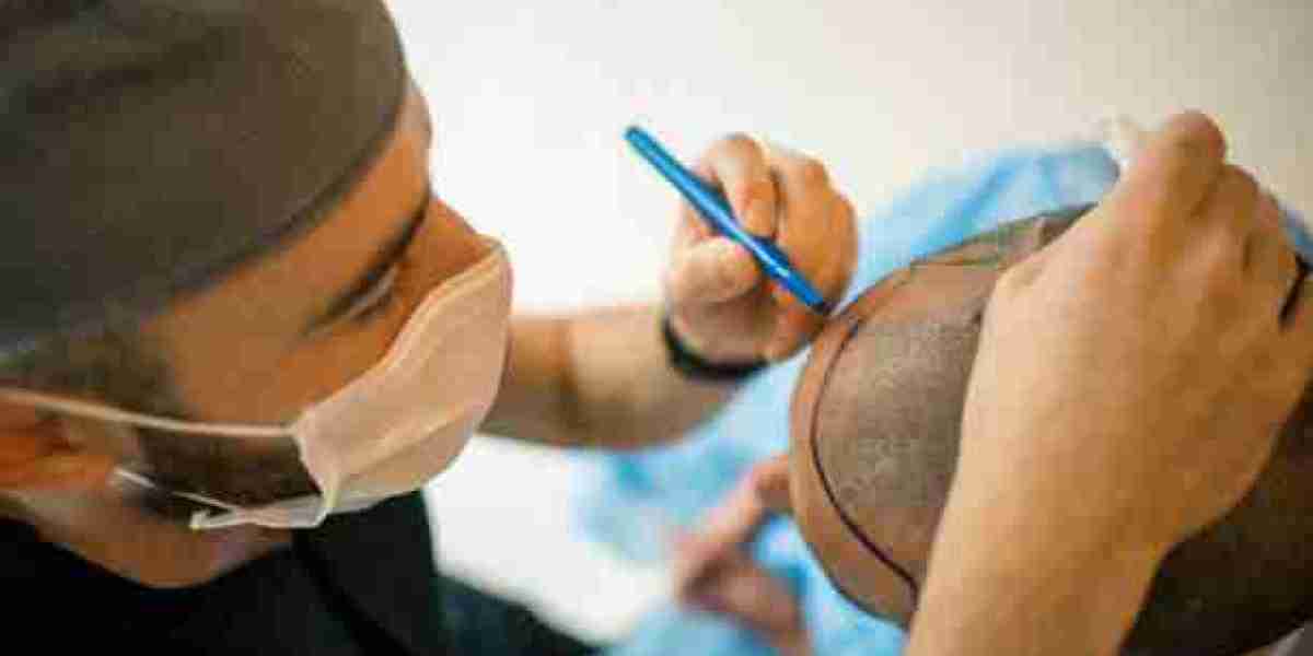 How Turkish Hair Transplants Enhance Confidence for Riyadh Residents