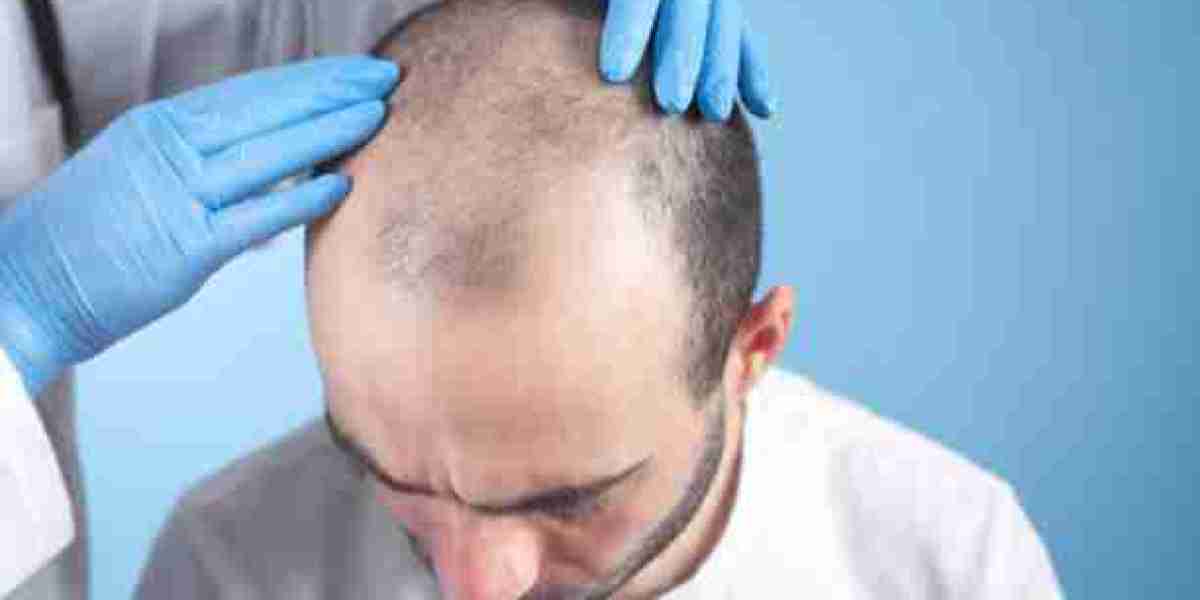 Understanding the Process of Turkish Hair Transplant in Riyadh