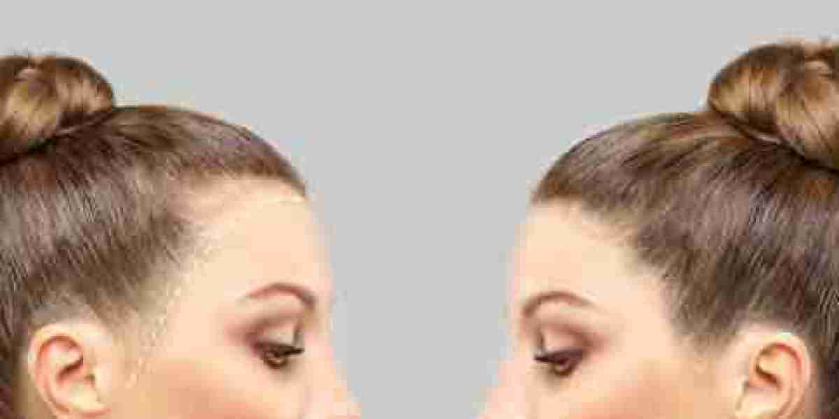 How to Prepare for Your Hair Transplant Surgery