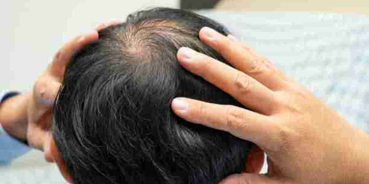 Exosomes Therapy for Hair Loss and Root Recovery Therapy