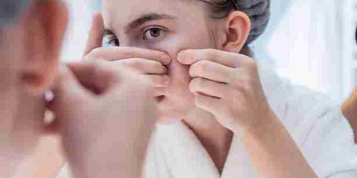 How to Choose the Right Acne Treatment for Your Skin in Riyadh