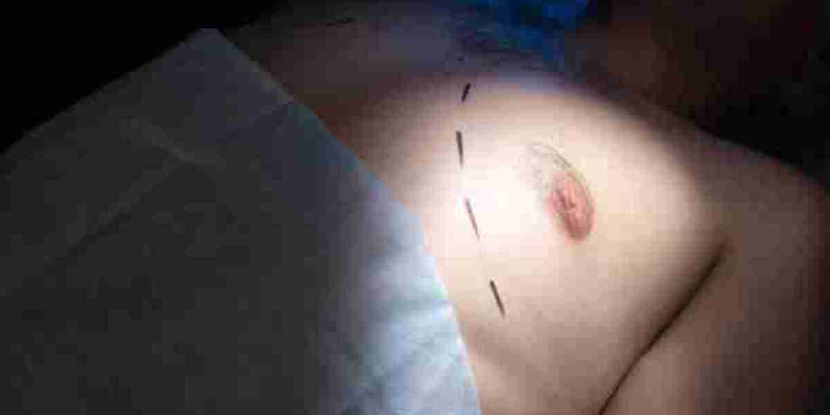 The Impact of Gynecomastia Surgery on Male Body Image in Riyadh