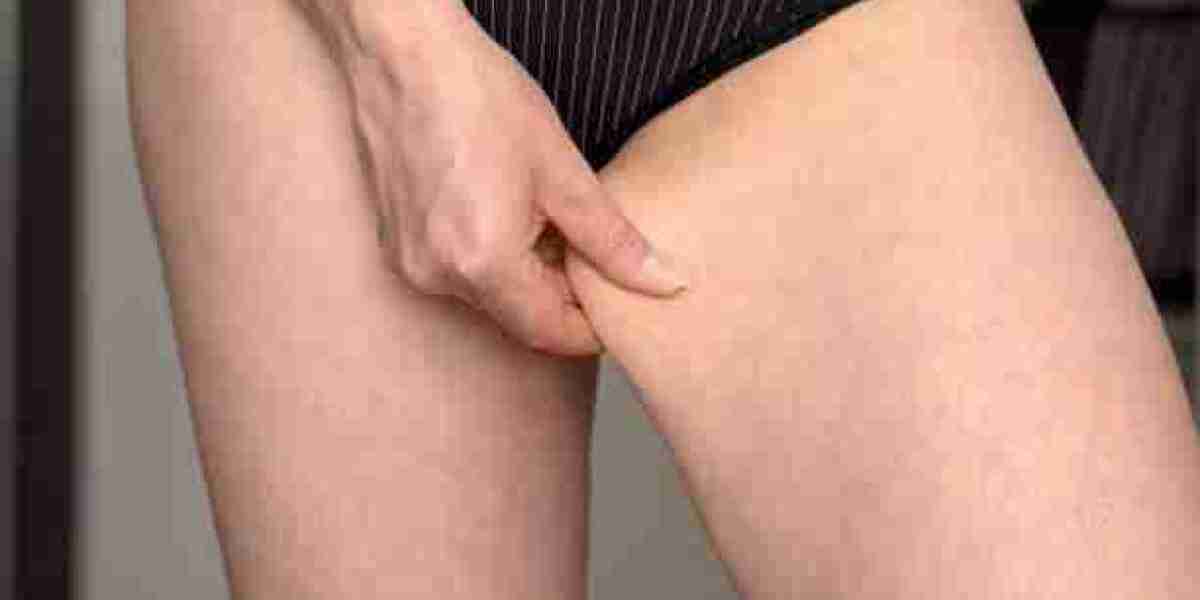 Lipedema Treatment Procedures for Long-Term Leg Support