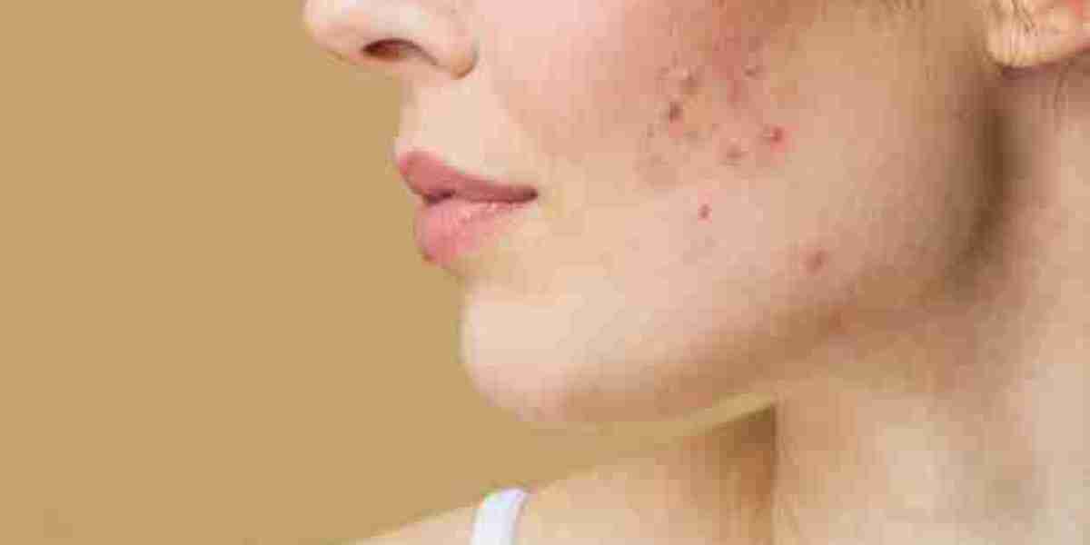 Pimples Treatment Remedies for Natural Skin Glow