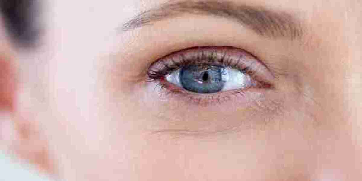 Eyelid Surgery Recovery Advice for Comfortable Post Treatment Care