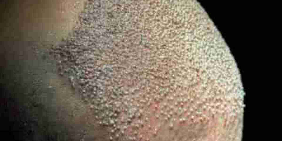 Hair Transplant in Riyadh: Is It Right for You?