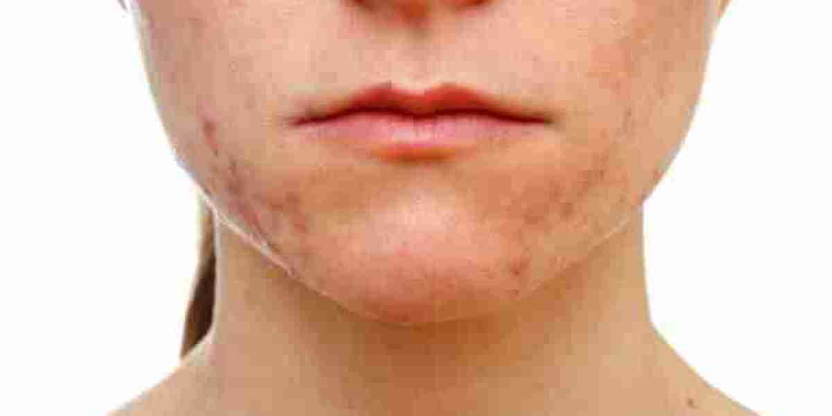 Acne Scar Treatment Methods That Support Complexion Enhancement