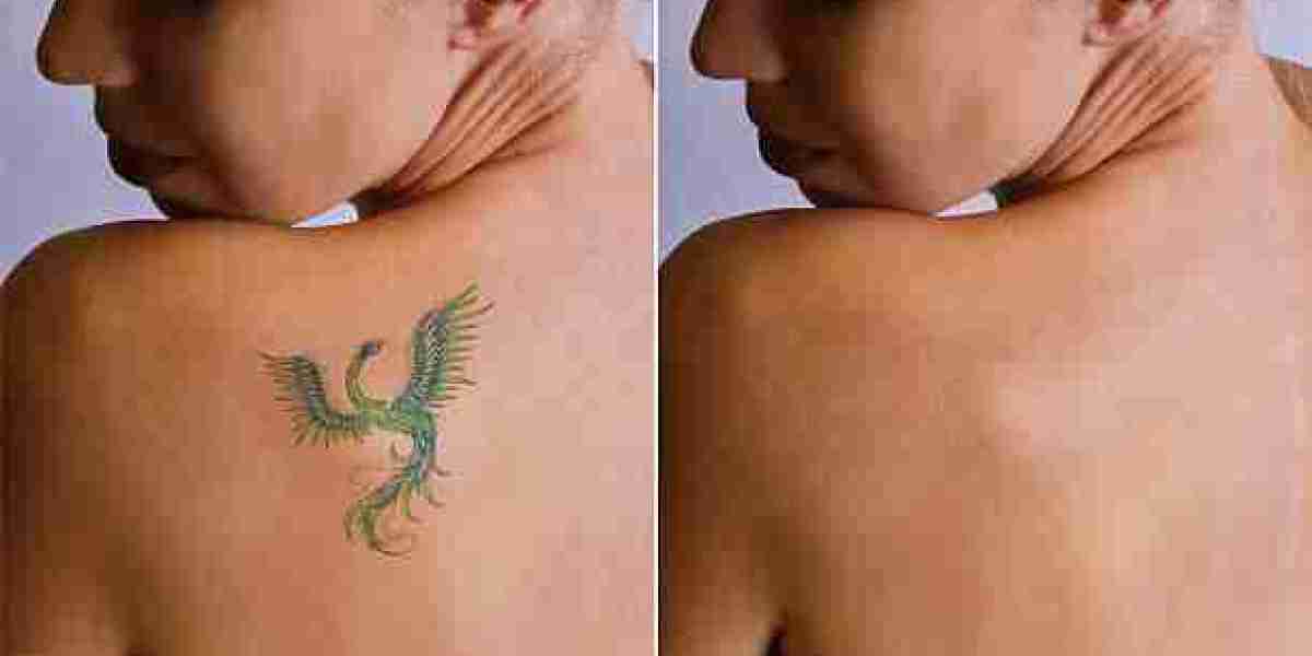 Laser Tattoo Removal for Professional Skin Care Results