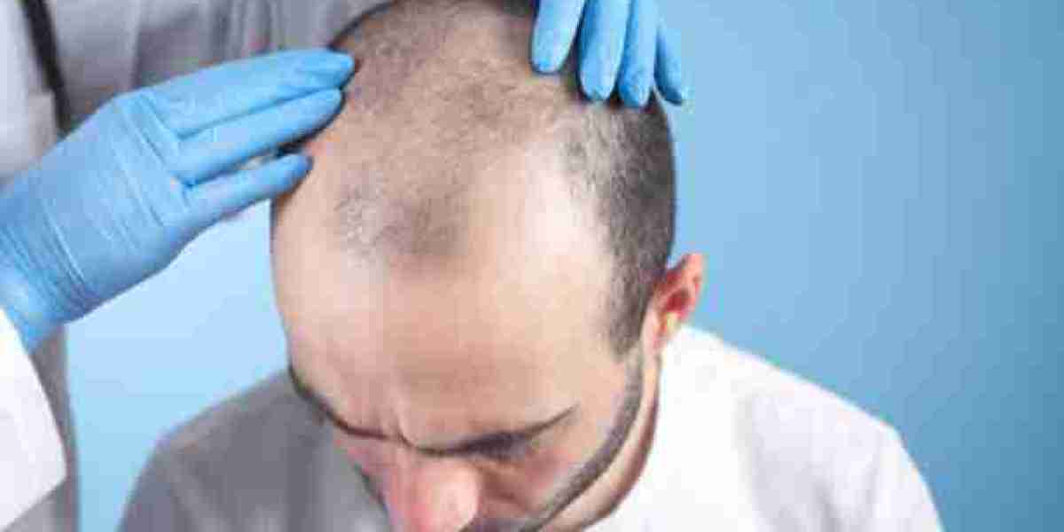 Hair Transplant Methods for Enhanced Hair Volume