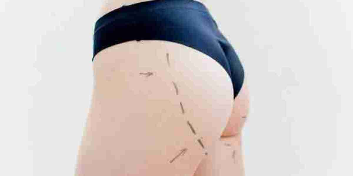 Enhancing Your Natural Curves with a Brazilian Butt Lift in Riyadh