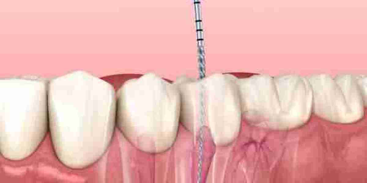 Root Canal Treatment to Prevent Tooth Loss