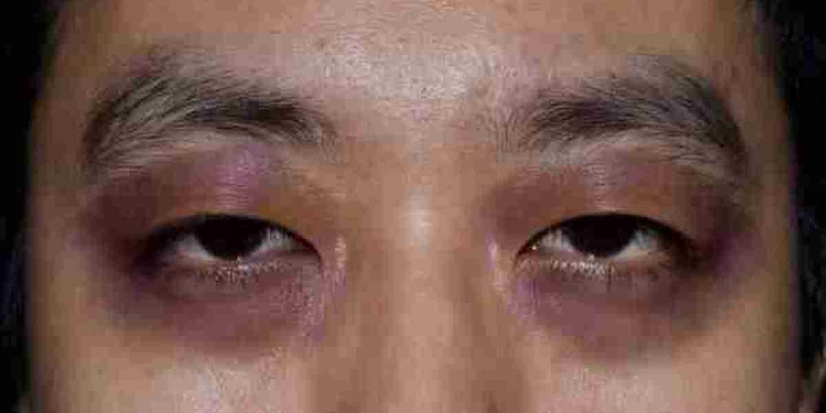 How to Choose the Right Clinic for Eye Bag Removal in Riyadh