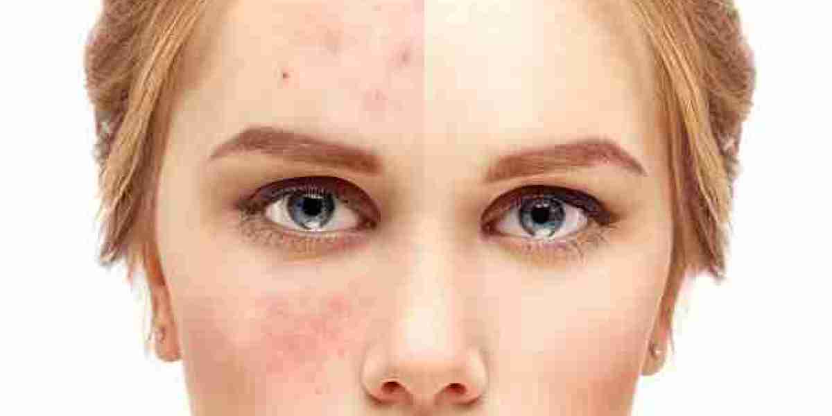 Acne Scar Treatment for Brighter Facial Skin