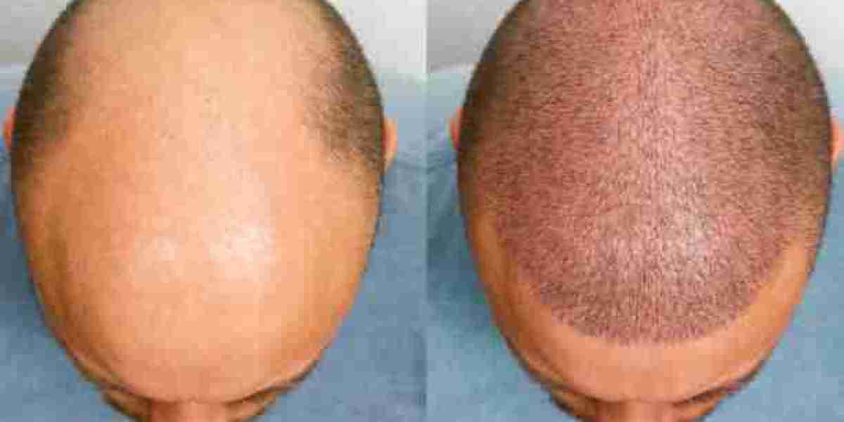 Hair Transplant Solutions That Inspire Confidence