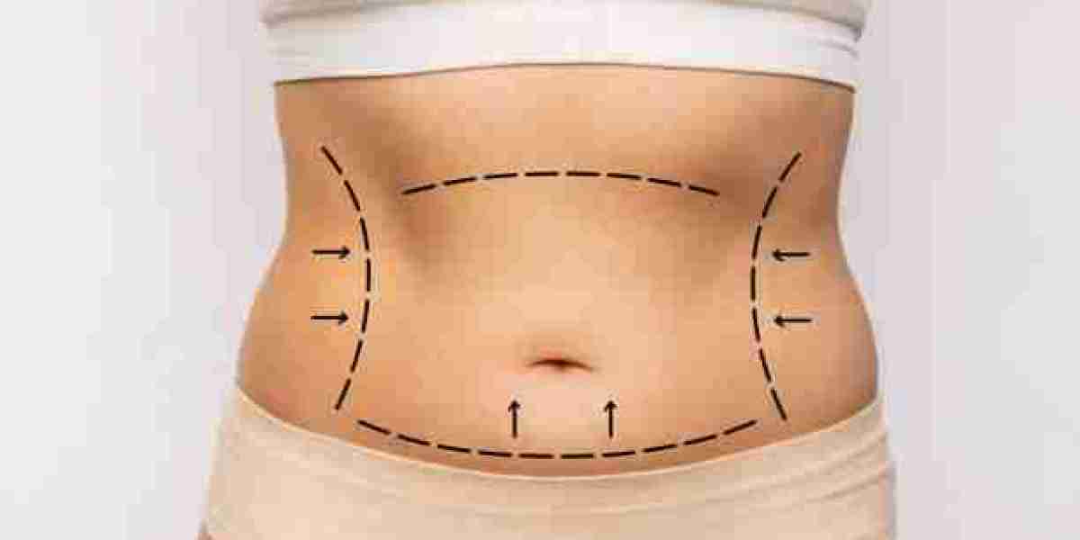 How Lipo Abdominoplasty Fits Into Your Overall Body Transformation Plan in Riyadh