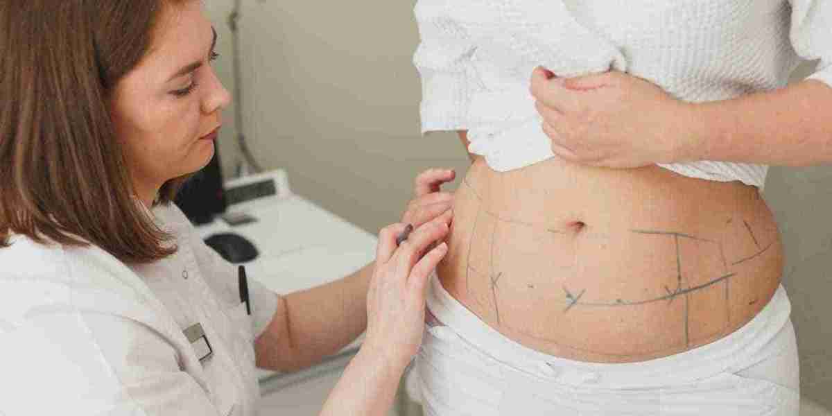 Liposuction for a More Attractive Body Shape