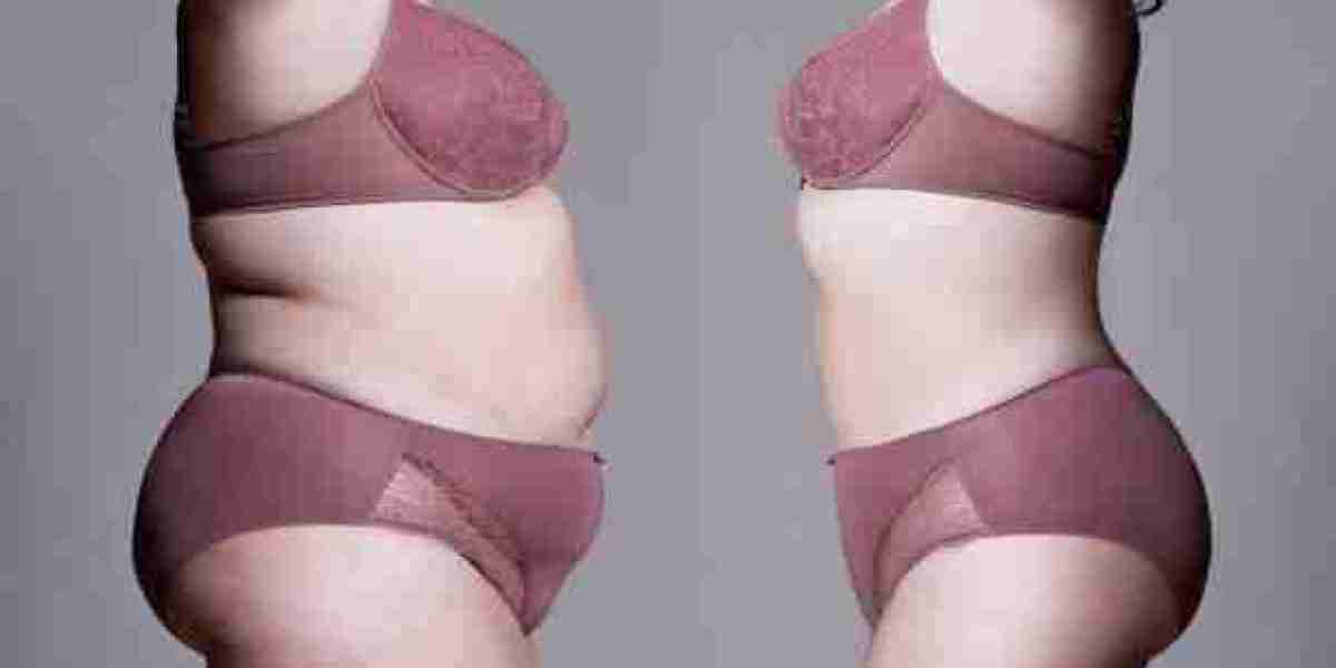 How Tummy Tuck Surgery Helps Restore Body Confidence