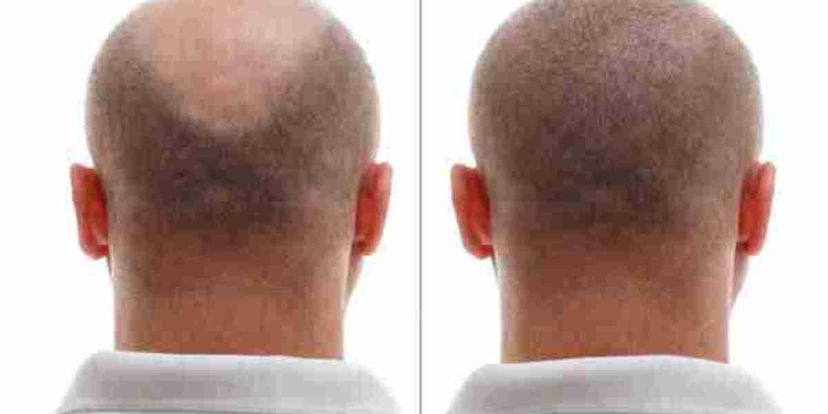 Hair Transplant for Rebuilding Hairline with Precision