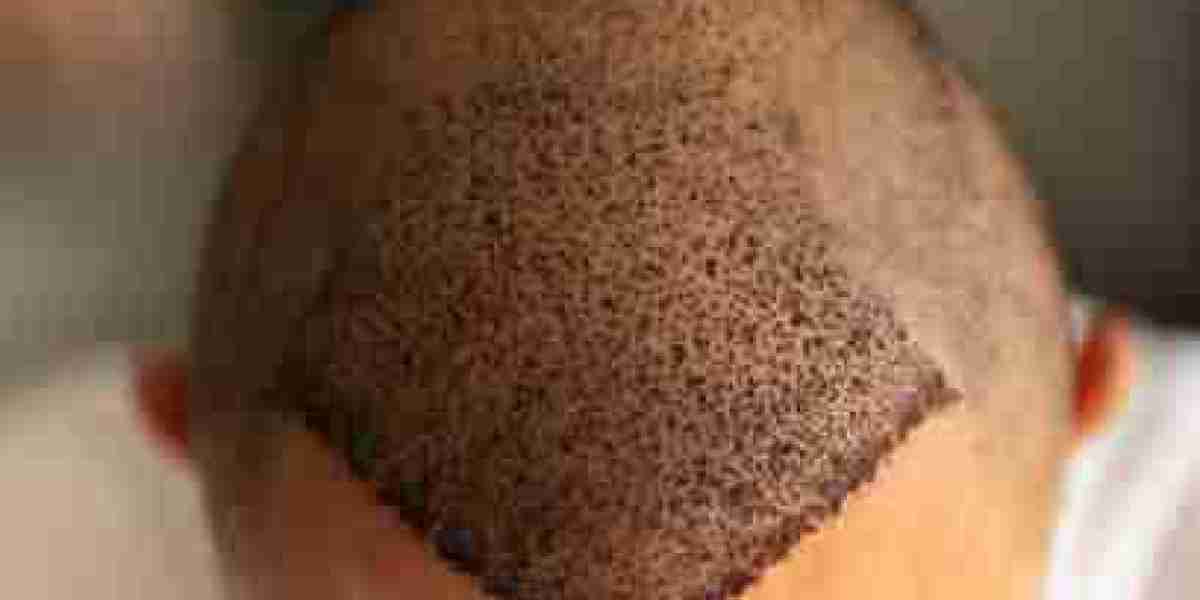 Hair Transplant Procedure That Revives Hair Growth