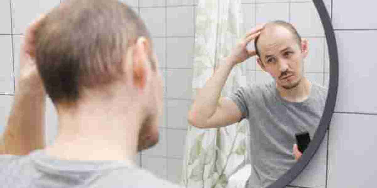 Understanding Causes and Treatments of Male Baldness Treatment in Riyadh