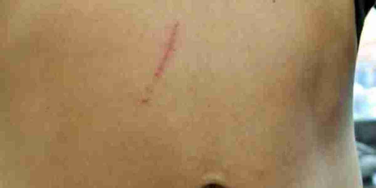 How Laser Scar Removal Supports Collagen and Skin Renewal