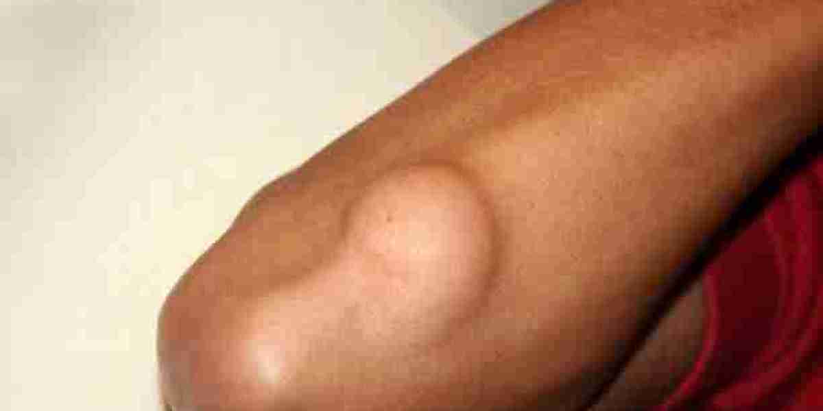 Lipoma Treatment Care for Long-Lasting Skin Wellness