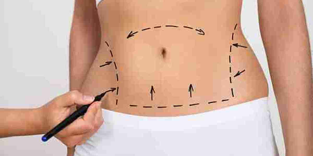 Liposuction and the Importance of Personalized Treatment