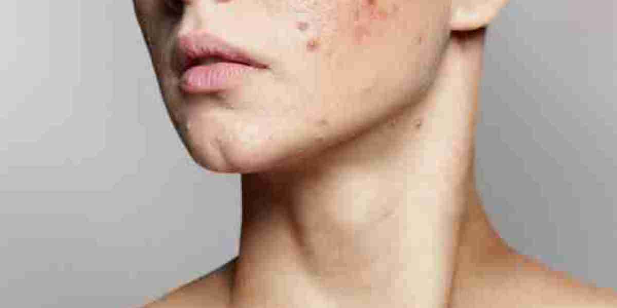 Pimples Treatment Explained for Better Skin Health