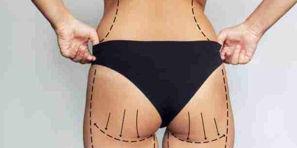 Exploring the Benefits of Mommy Makeover in Riyadh Treatments
