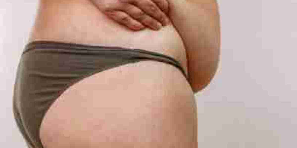 Lipedema Treatment and Self-Care Practices for Ongoing Symptom Support