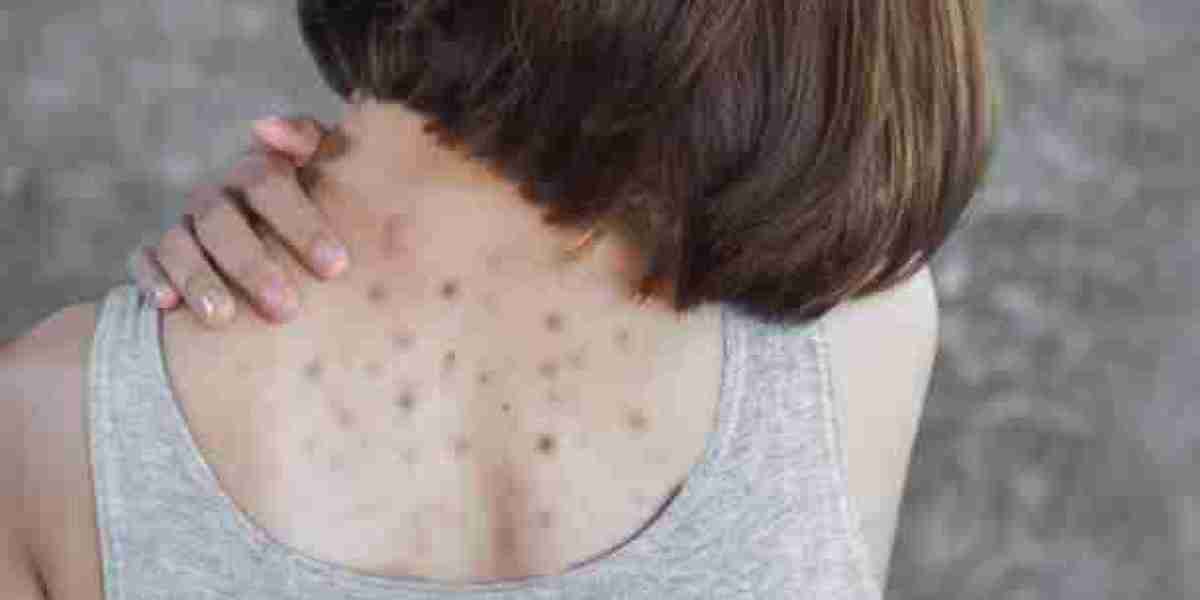 The Best Exfoliants for Back Acne in Riyadh