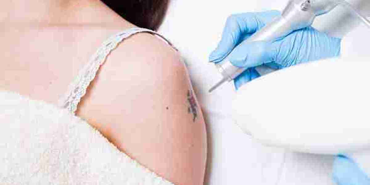 Laser Tattoo Removal for Those Seeking a Cleaner Skin Appearance