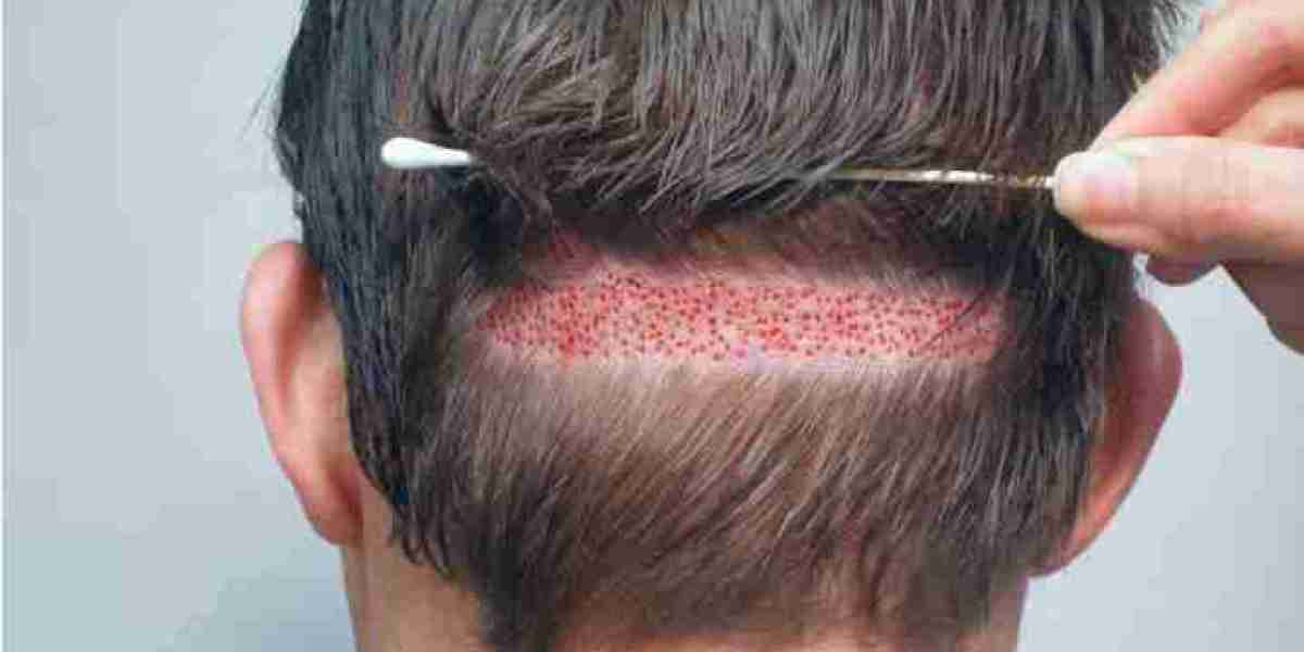 Hair Transplant in Lahore: Your Step-by-Step Guide