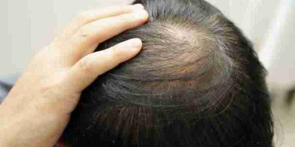 Hair Loss Treatment for Addressing Early Signs of Hair Thinning