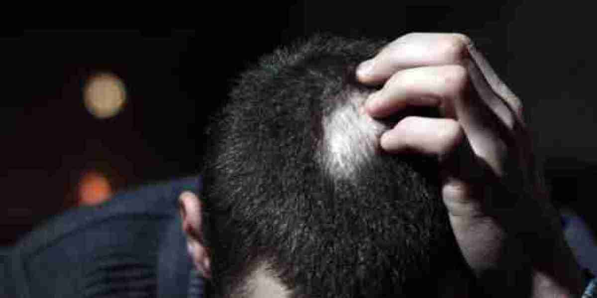 Alopecia Areata Treatment Guide for Understanding Your Treatment Options