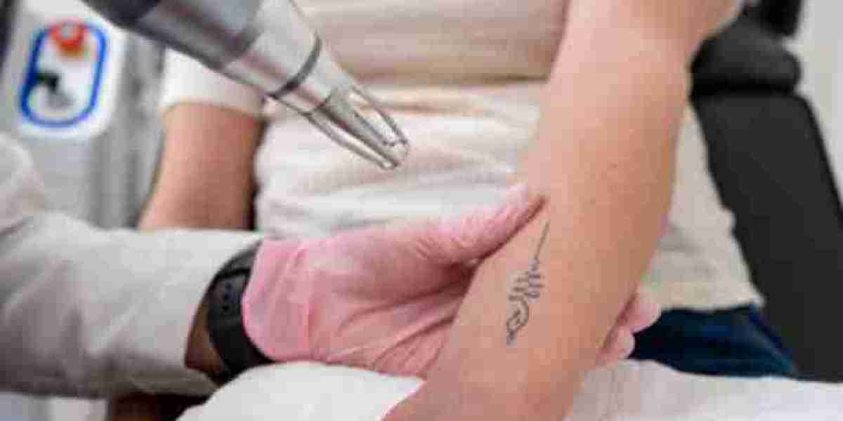 Laser Tattoo Removal for Correcting Regretful Tattoo Choices