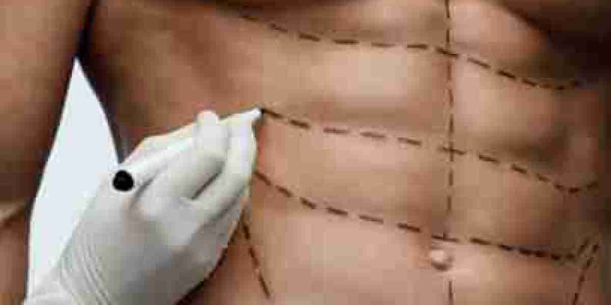 Liposuction for Managing Localized Fat in Different Body Areas