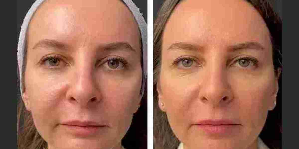 Best Plastic Surgeons in dubai: Mesotherapy Sun-Damaged Skin Treatment
