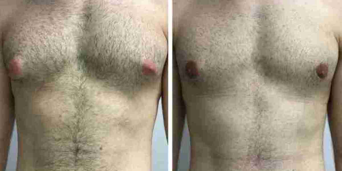 How Gynecomastia in Dubai Addresses Excess Skin Around Areolas