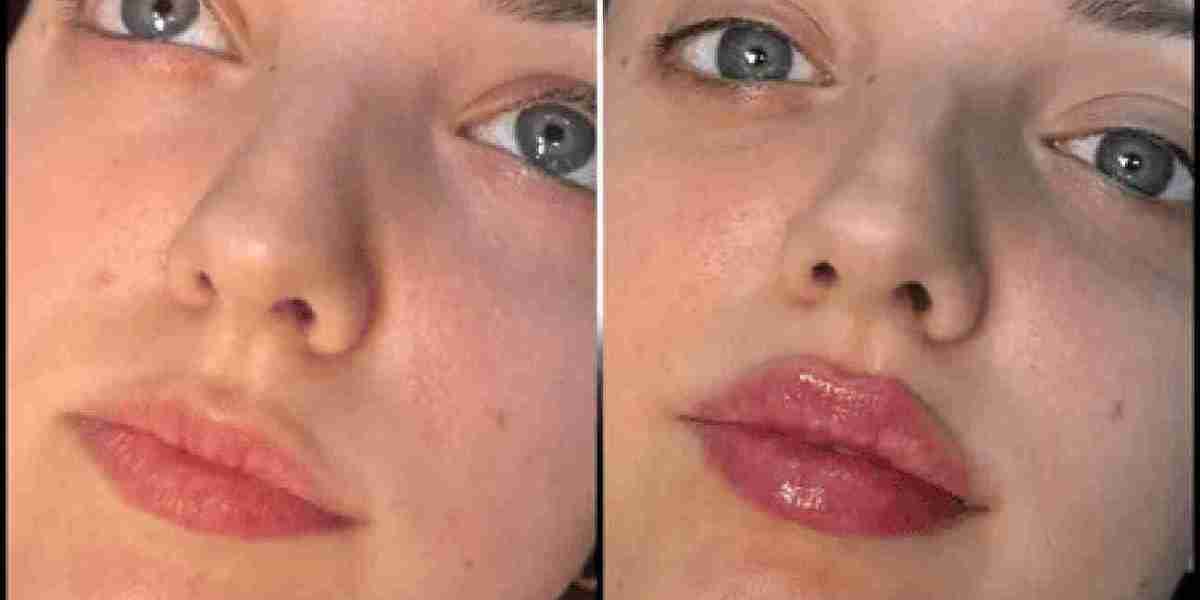 Fillers in Dubai: The Key to Age-Defying Beauty