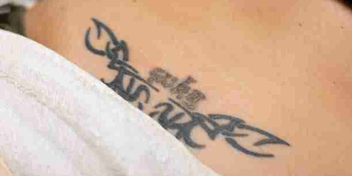 Your Guide to Laser Tattoo Removal in Riyadh