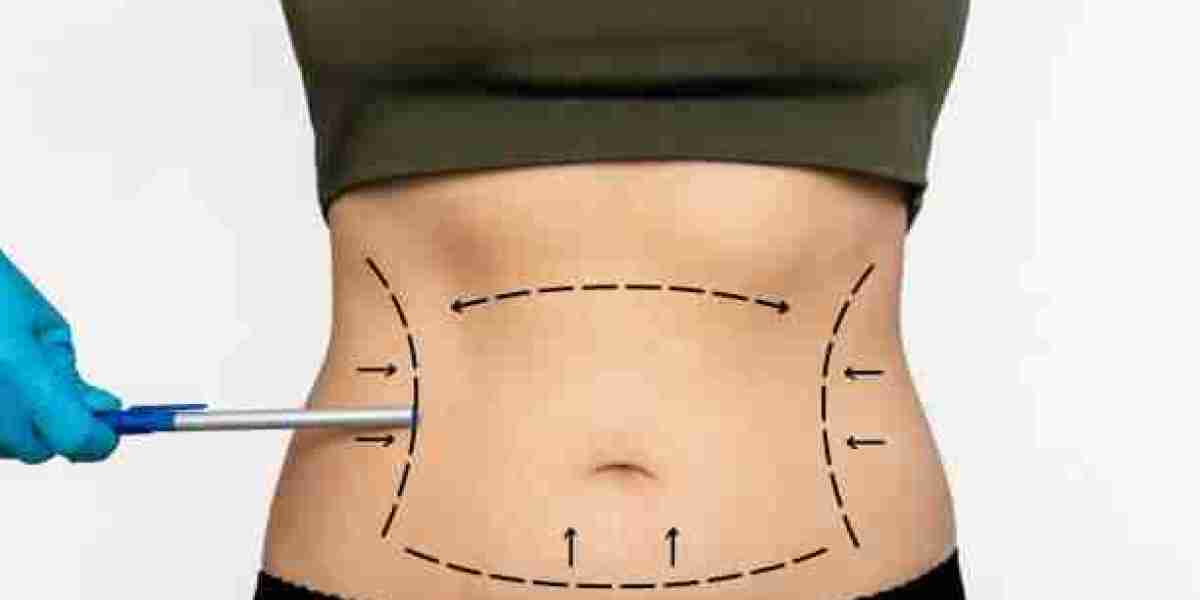 My Experience With Vaser Liposuction and Following Aftercare Advice