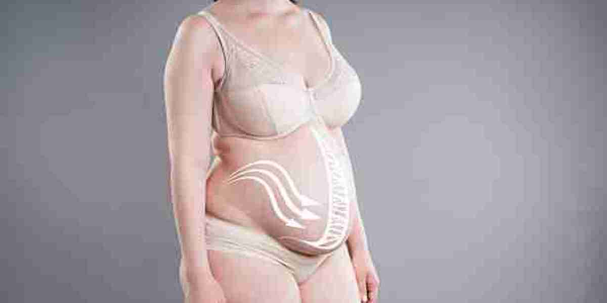 Tummy Tuck Surgery for Patients With Persistent Abdominal Skin Sagging