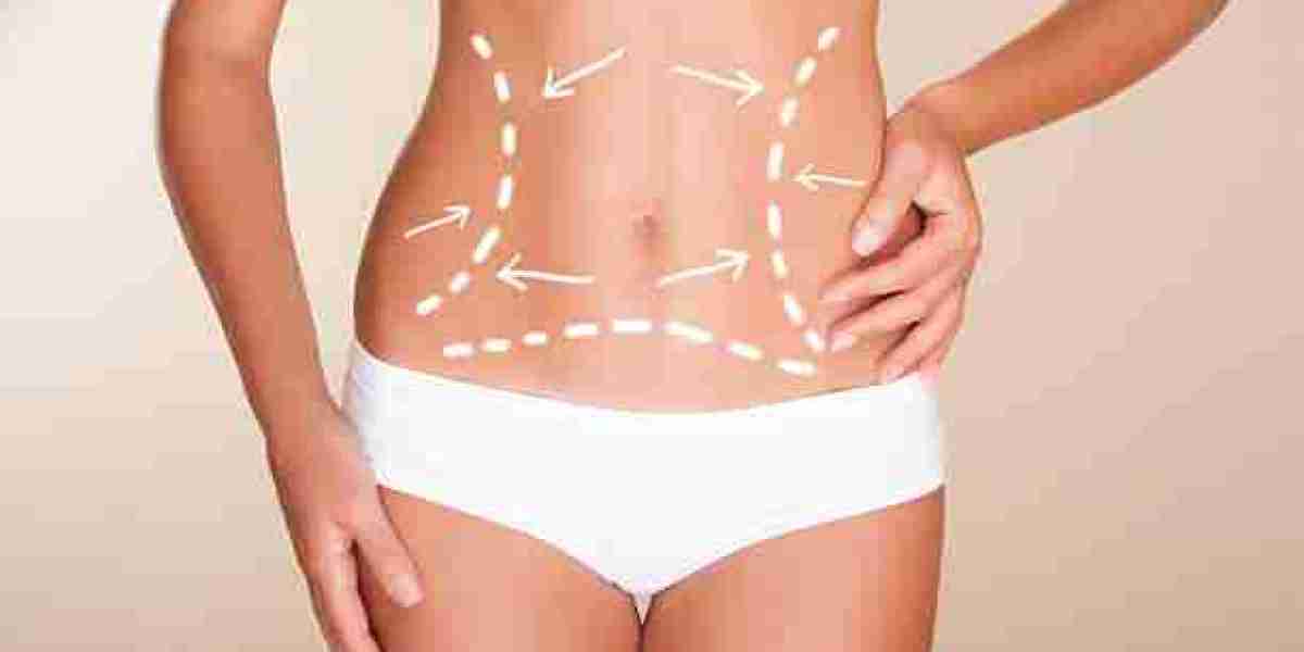 Understanding Liposuction in Riyadh for Targeted Body Shape Improvement