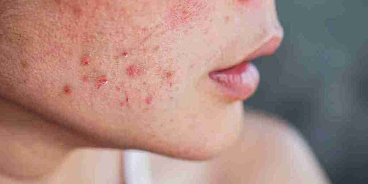 Professional Skin Assessment for Acne Treatment in Dubai