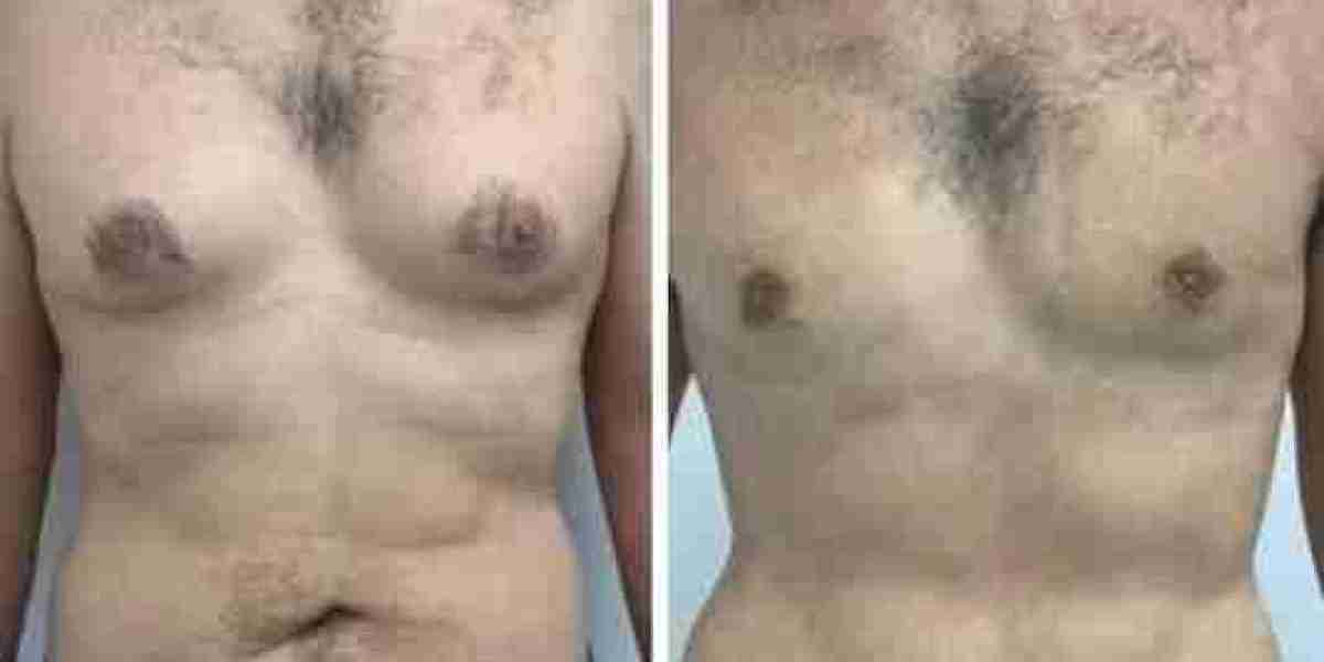Gynecomastia Surgery in Dubai: Exploring Comprehensive Treatment Options