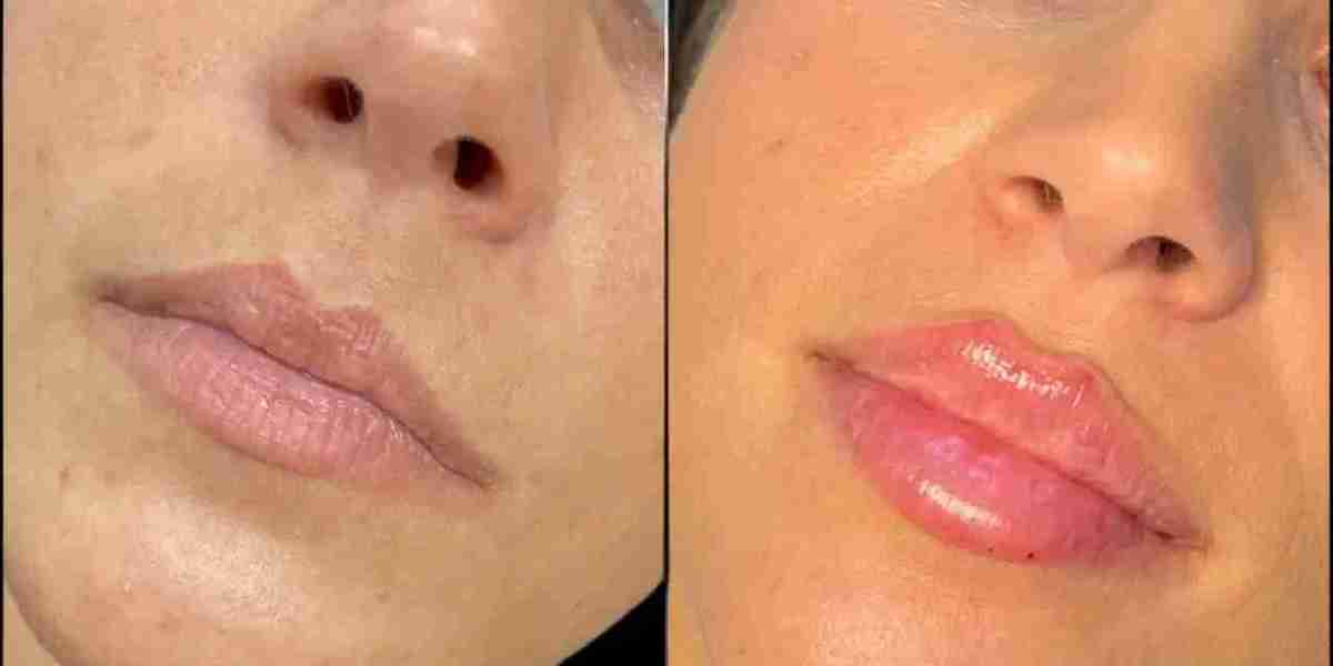Dermal Fillers Treatment in Dubai for Facial Enhancement